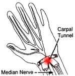 carpal tunnel