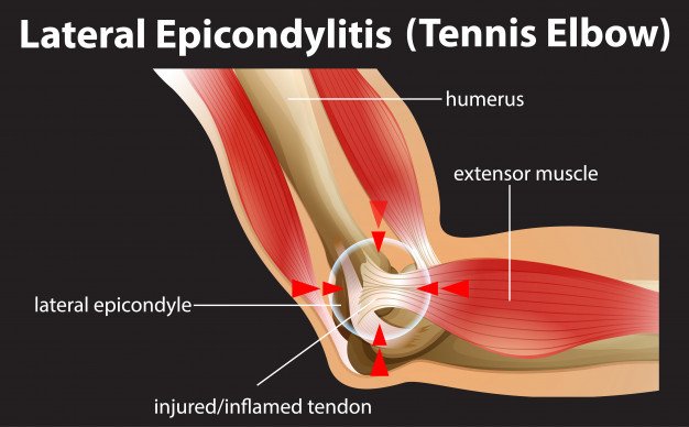 Tennis Elbow