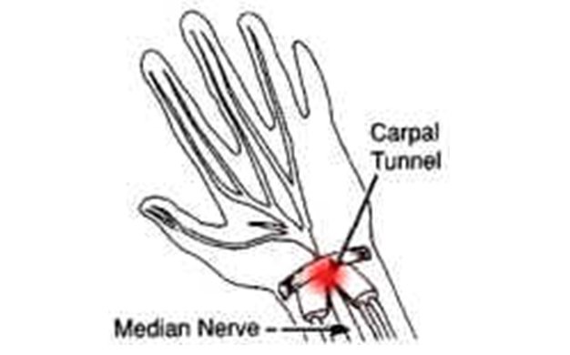 Carpal Tunnel Syndrome: Causes and Treatment